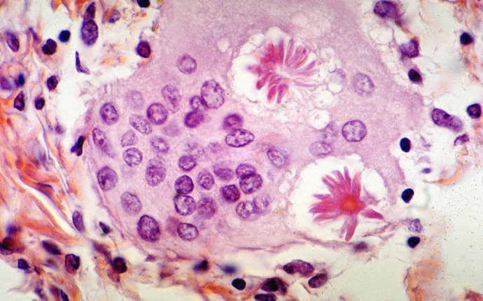 Sarcoidosis - Asteroid bodies | Asteroid bodies are stellate… | Flickr